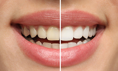 Before-and-after smile comparison showing improved tooth color and alignment from dental treatment.